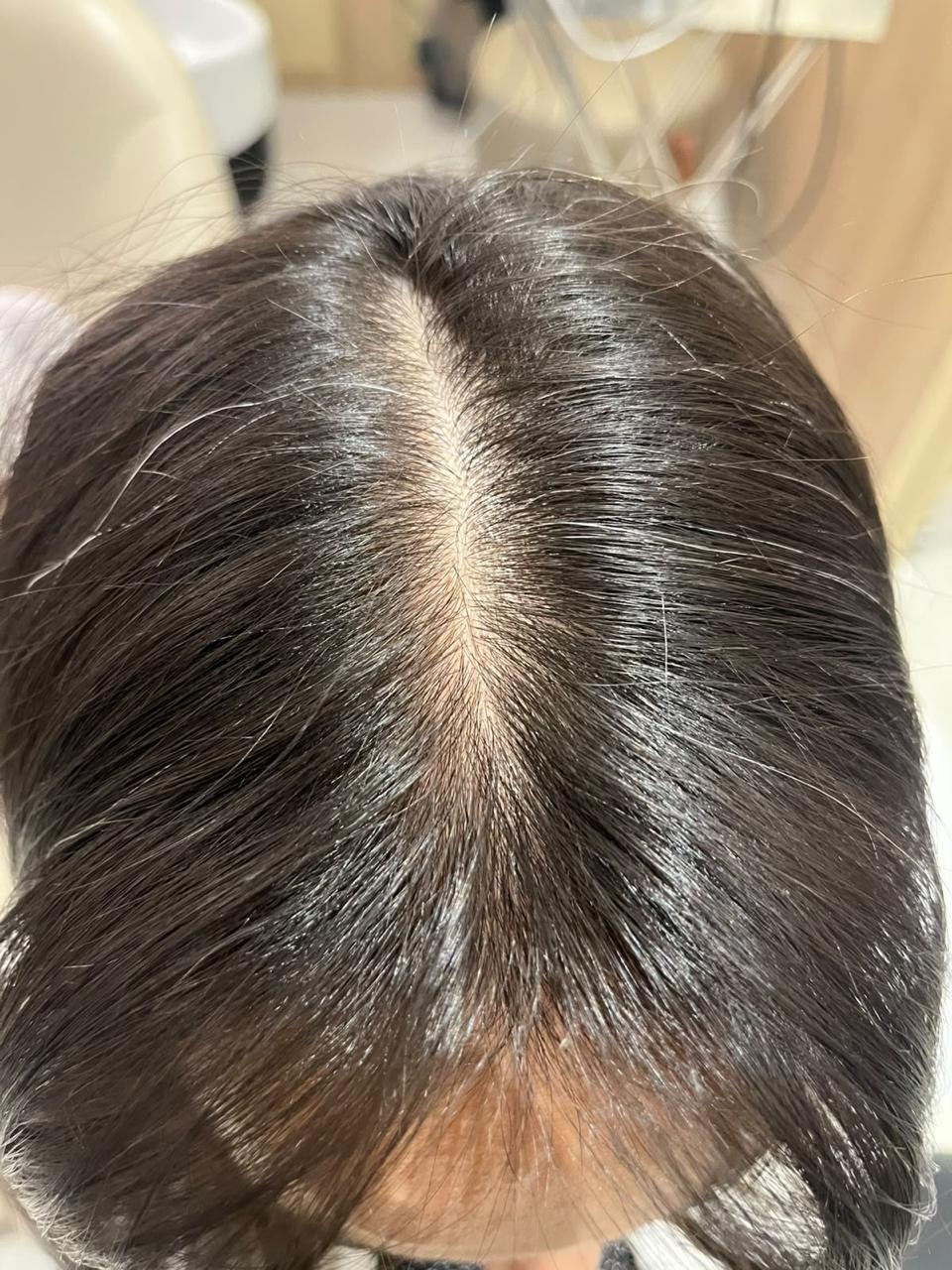 Couro cabeludo de cliente depois do uso do Shampoo Therapy